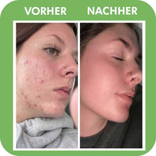 Lade das Bild in den Galerie-Viewer, SKINCARY™ -  Poren Tiefenreinigungsmaske

